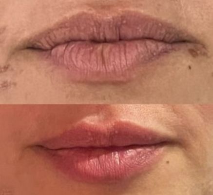 acido hialuronico para labios bogota