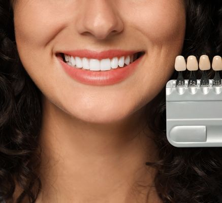 carillas dentales en bogota