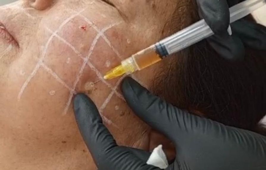 mesoterapia en bogota