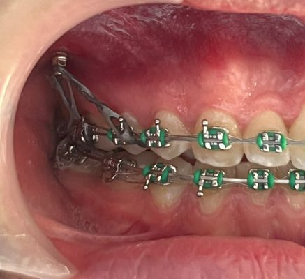 ortodoncia con mini implantes bogota