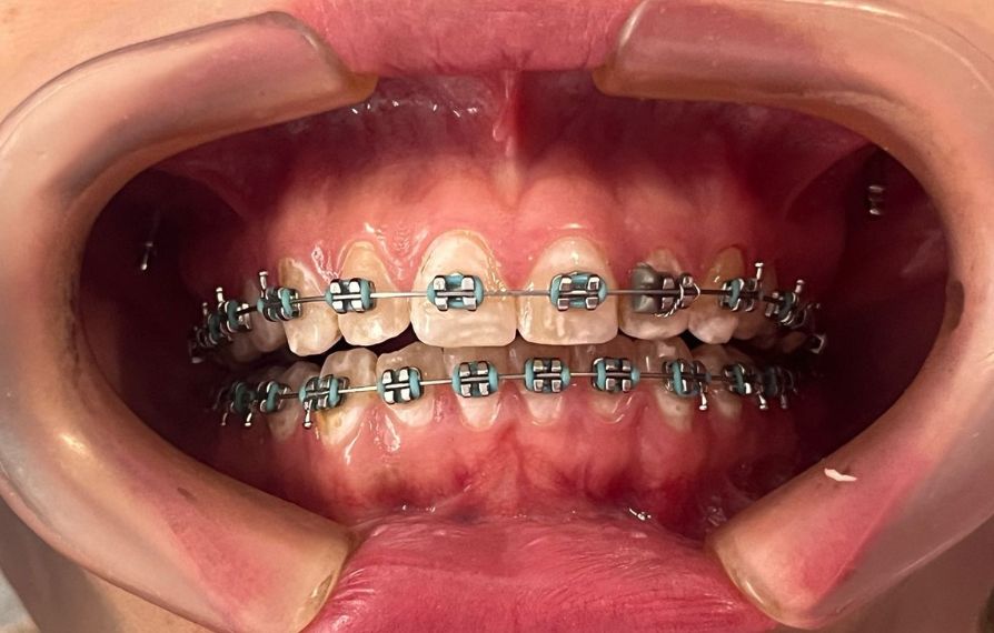 ortodoncia con mini implantes