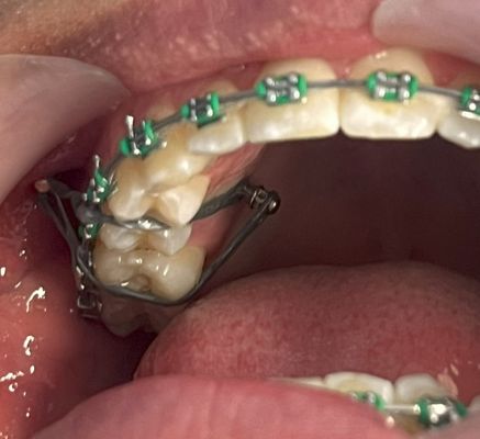 ortodoncia con mini implantes en chia