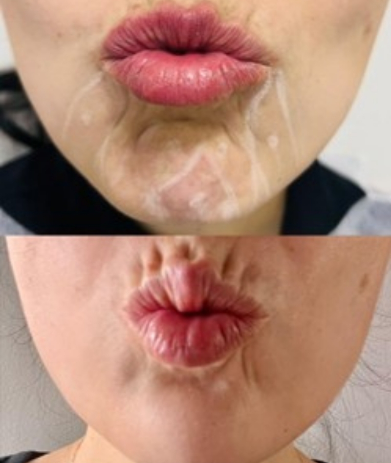 rejuvenecimiento facial en cajica
