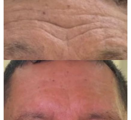 tratamientos de reduccion de arrugas en bogota